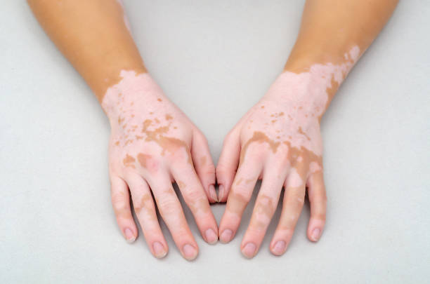 istock Vitiligo on skin of hands. 1167995300