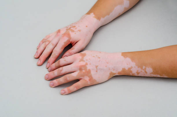 istock Vitiligo on skin of hands. 1167995304