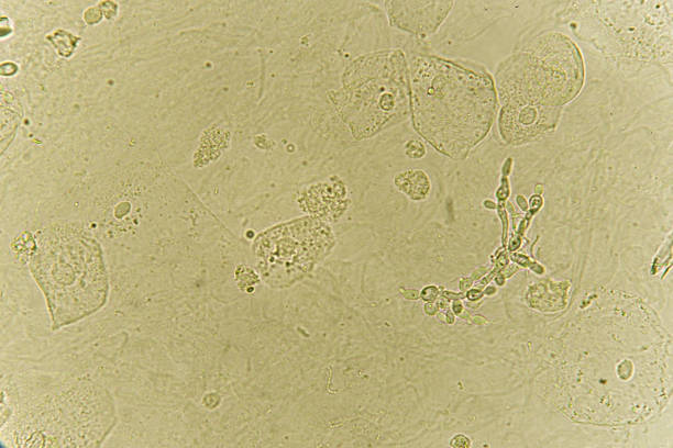 istock Pseudohyphae and budding yeast cells in patient urine 1168014640