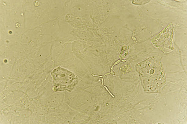 istock Pseudohyphae and budding yeast cells in patient urine 1168014646