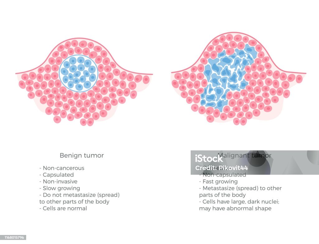 Vektorillustration Von Bösartigen Und Gutartigen Tumor Stock Vektor Art und mehr Bilder von ...