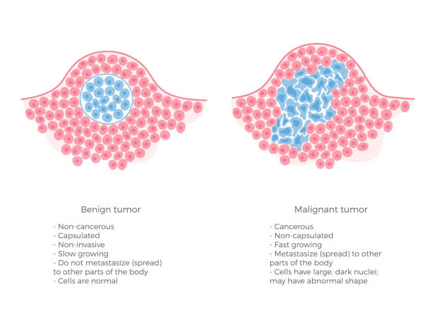 ilustrações de stock, clip art, desenhos animados e ícones de vector illustration of malignant and benign tumor - microscope science healthcare and medicine isolated