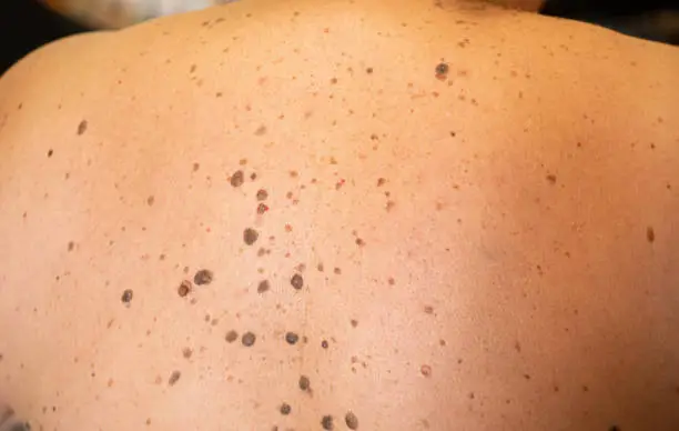 woman patient on clinical trials with lot on brown nevus on body back