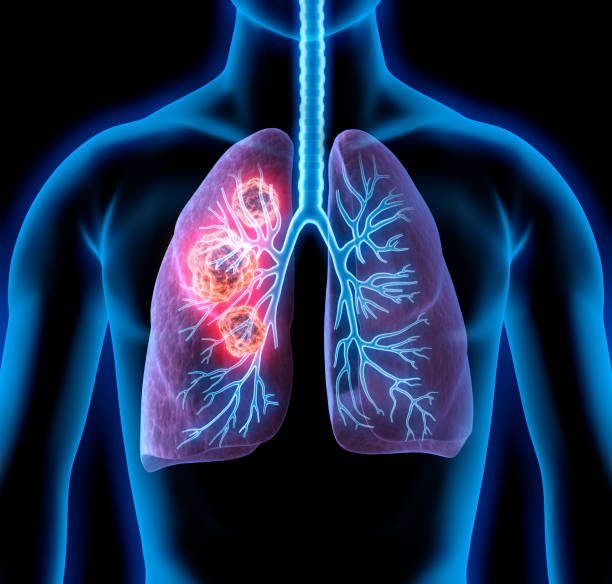cuerpo con tumor pulmonar - imagen de rayos x fotos fotografías e imágenes de stock