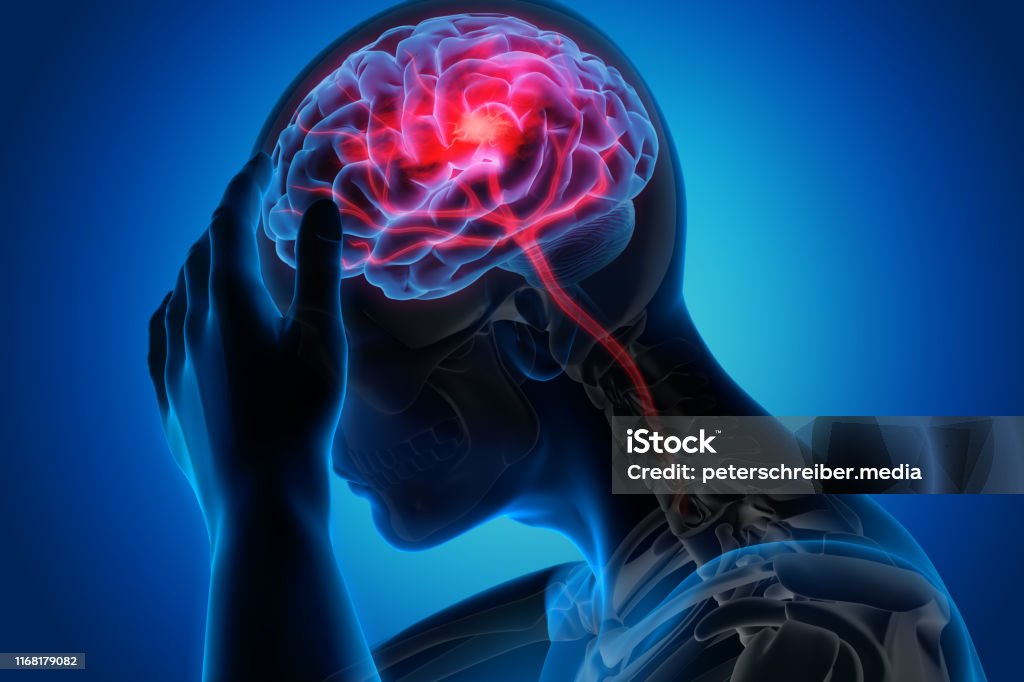 Man with brain stroke symptoms Medical illustration of a brain with stroke symptoms Stroke - Illness Stock Photo