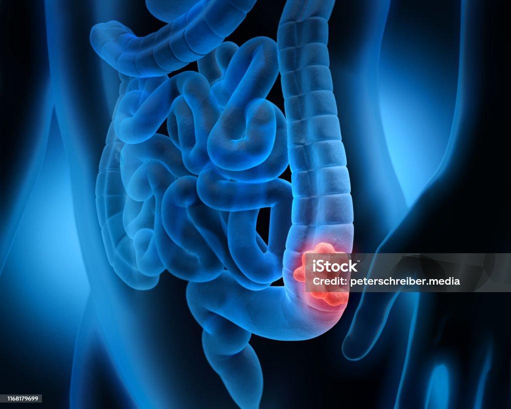 대장암의 3d 삽화 종양 대장암에 대한 스톡 사진 및 기타 이미지 - 대장암, 암, 결장 - iStock