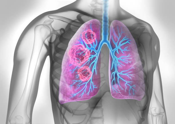 istock Body with lung tumor 1168181199