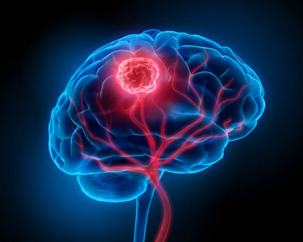 istock Isolated blue glowing brain with tumor 1168181296