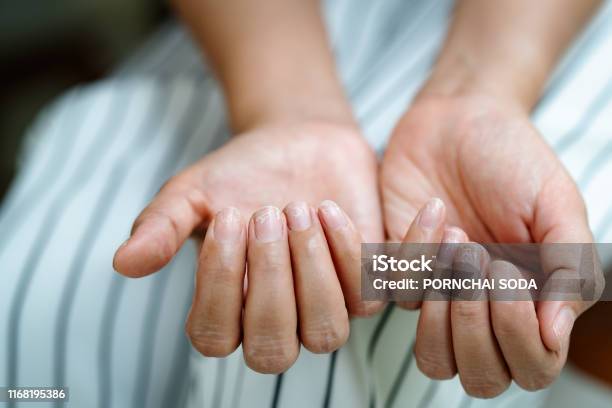 Brittle Damaged Nails After Using Shellac Or Gellacquer Stock Photo - Download Image Now