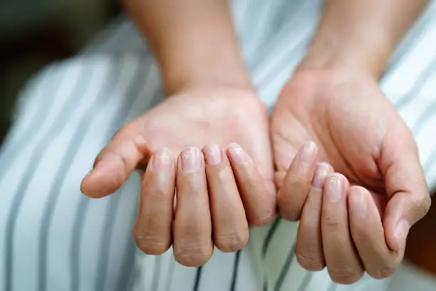 Photo of brittle damaged nails after using shellac or gel-lacquer