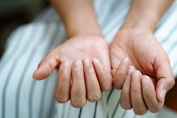 łamliwe uszkodzone paznokcie po użyciu szelaka lub żelu-lakieru - fingernail zdjęcia i obrazy z banku zdjęć