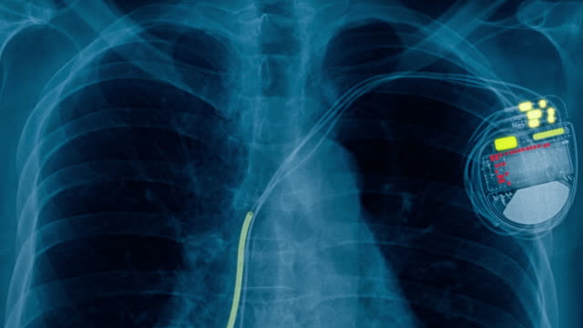 x-ray footage pacemaker cell