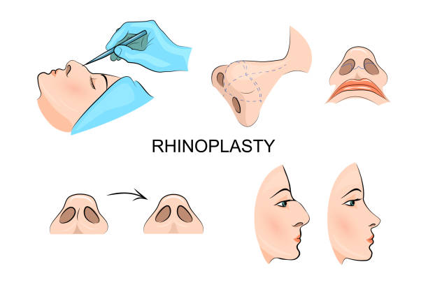 ilustrações, clipart, desenhos animados e ícones de rinoplastia. cirurgia estética. medicina estética. vetor - hump