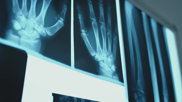 3,107 Osteoporosis Stock Videos and Royalty-Free Footage - iStock | Osteoporosis bone, Bone density, Bone 3,107 Osteoporosis Stock Videos and Royalty-Free Footage - iStock | Osteoporosis bone, Bone density, Bone