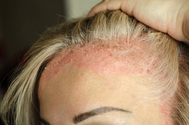 maladie de la peau dermatologique. psoriasis, eczéma, dermatite, allergies. lésions cutanées sur les coudes. - eczema photos et images de collection