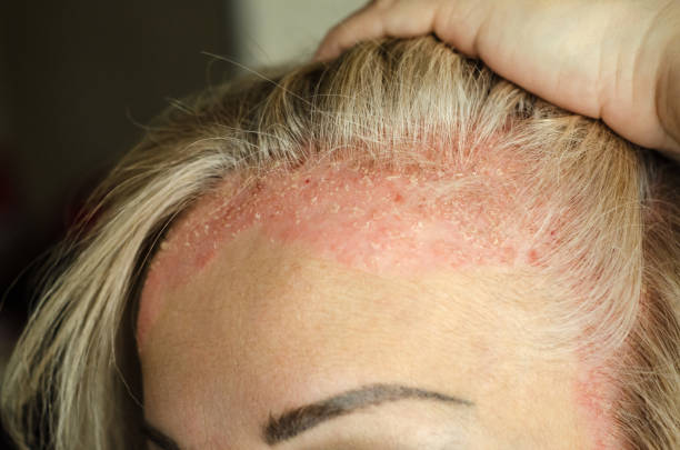 Dermatological skin disease. psoriasis, eczema, dermatitis, allergies. Skin lesions on the elbows. Dermatological skin disease. psoriasis, eczema, dermatitis, allergies. Skin lesions on the head. Red areas on forehead and ears. east slavs stock pictures, royalty-free photos & images