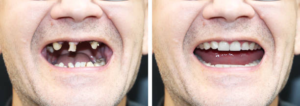 der patient beim kieferorthopäden vor und nach dem einbau von zahnimplantaten. zahnverlust, zerfallene zähne, prothese, veneers - menschlicher zahn fotos stock-fotos und bilder