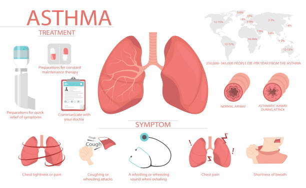 asthma Detail about of asthma symptoms and causes have man. Medical education chart of biology for lungs diagram. Vector illustration in flat style for medical atlases, articles, infographics. bronchiole stock illustrations