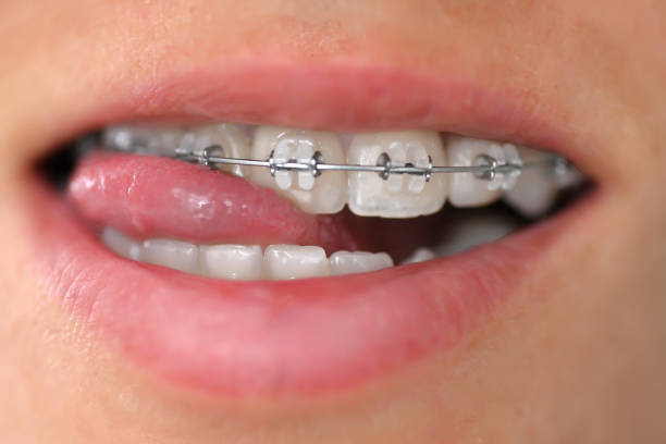 brasket system in smiling mouth, close-up lips