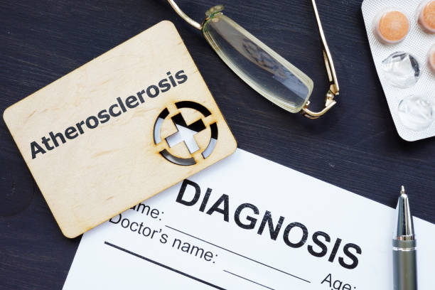 istock Writing note showing Atherosclerosis. The text is written on a small wooden board with red cross silhouette. There are pills, blister, glasses, diagnosis, table on the photo. 1168770402