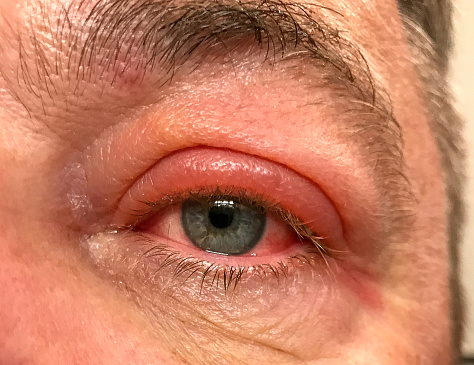 Extremo de cerca a un hombre con el ojo rojo inflamado photo