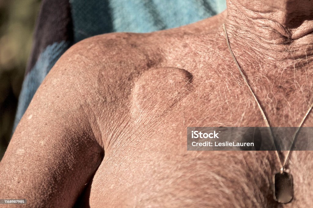 Woman With Pacemaker Pacemaker Stock Photo - Download Image Now - Pacemaker, Medical Exam ...
