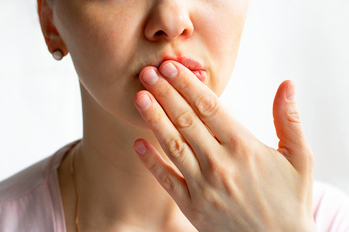 Parte inferior de la cara de la mujer con burbujas rojas de herpes del virus en sus labios, se esconde con la palma de la mano sobre fondo blanco, Zoster, Frío, Medicina, Tratamiento. Horizontal photo