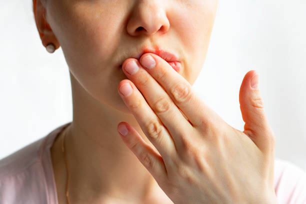 partie inférieure du visage de femme avec des bulles rouges d'herpès de virus sur ses lèvres, elle se cache avec sa paume sur le fond blanc, zoster, froid, médecine, traitement. horizontal - bouche humaine photos et images de collection