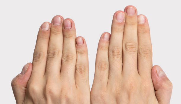mano masculina mordedora de uñas - nail biting biting fingernail obsessive fotografías e imágenes de stock