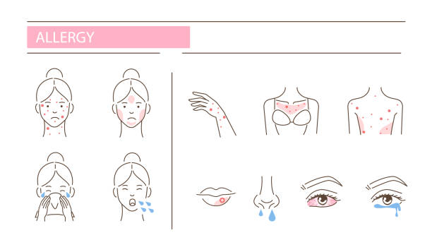 allergy Woman has allergy diseases symptoms - skin rash, cough, snot, conjunctivitis. Set of  icons about dermatitis illness signs. Flat line vector illustration isolated on white background. dna virus stock illustrations