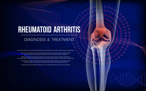 Rheumatoid arthritis Bones the of knee Rheumatoid artritic sore joints concept. Realistic bones of knee skeleton, human leg. Horizontal dark blue banner for rheumatoid arthritis advertising, medical publications. Vector illustration stock. human joint stock illustrations