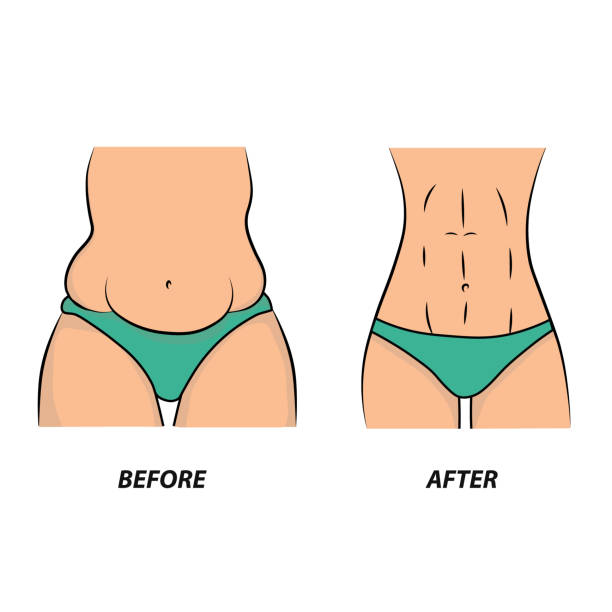 Thick and thin, overweight problems concept. Part of female torso with fat and lean abdomen and hips. Tummy before and after diet, fitness or liposuction. Vector illustration. silicone implants stock illustrations