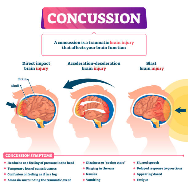Concussion vector illustration. Labeled educational post head trauma scheme Concussion vector illustration. Labeled educational post head trauma scheme. Medical explanation with brain injury kinds. Direct impact, acceleration and blast health causes with symptoms list diagram concussion stock illustrations