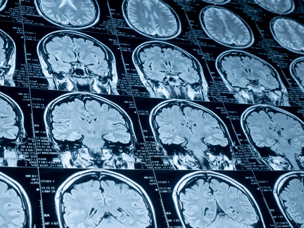 istock MRI Brain Scan of head and skull 1169591712