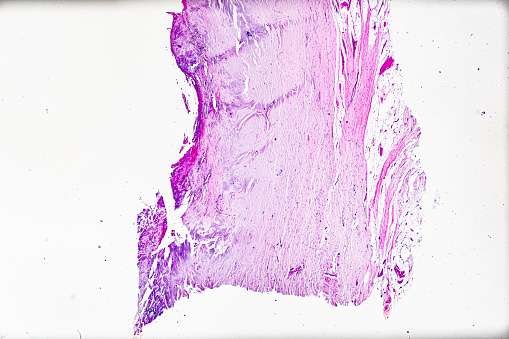 Connective tissue, hyaline degeneration biopsy under light microscopy zoom in different areas
