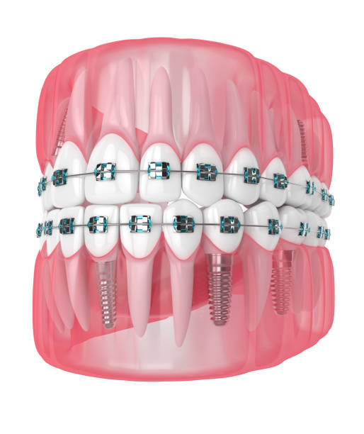 istock 3d render of jaw with implants and orthodontic braces 1169687736