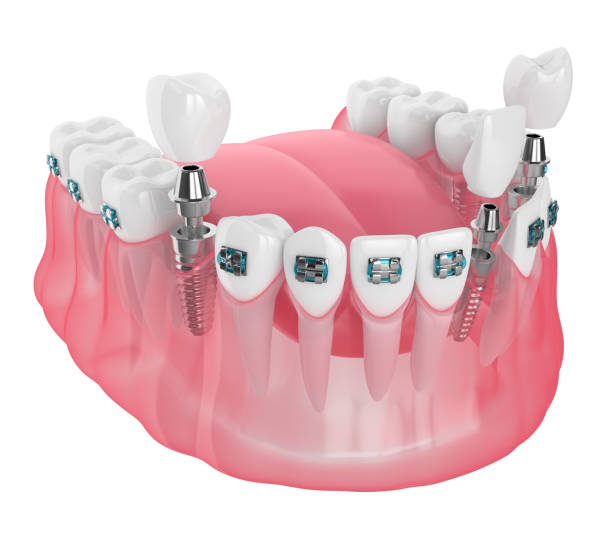 istock 3d render of jaw with implants and orthodontic braces 1169687739