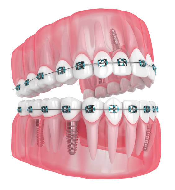 istock 3d render of jaw with implants and orthodontic braces 1169687740