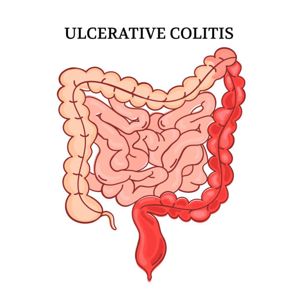 illustrazioni stock, clip art, cartoni animati e icone di tendenza di colite ulcerosa intestino medicina anatomia vector scheme - alimentary