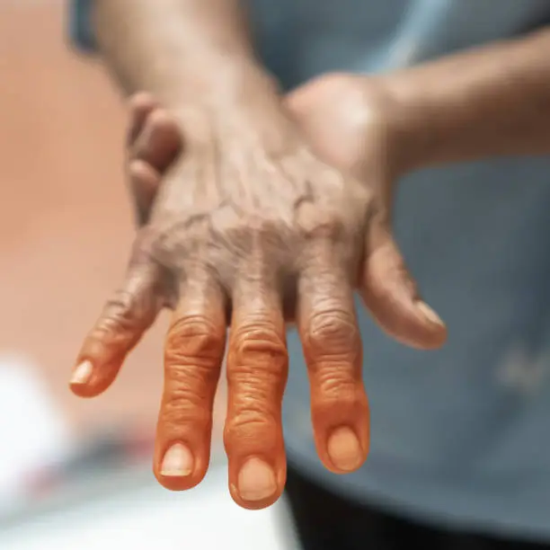 Photo of Peripheral Neuropathy pain in elderly ageing patient on hand, palm, fingers, joint and sensory nerves with numb, aching, muscle weakness,  stabbing, burning or tingling sensory feeling