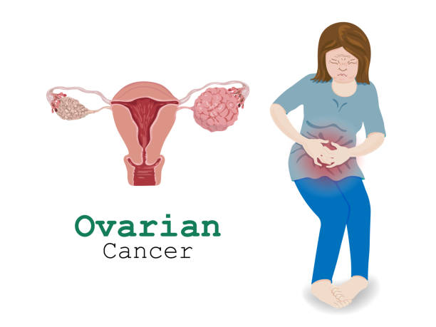 istock Woman pain with Ovarian Cancer. 1170072687