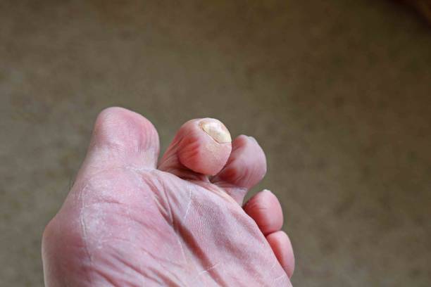 hammerzehendeformität des fußes - podiatry chiropody toenail human foot stock-fotos und bilder