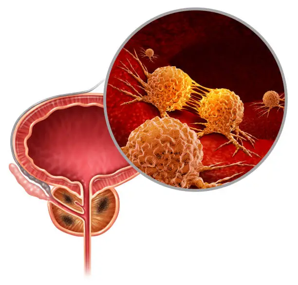 Cancer of the prostate medical concept as cancerous cells in a male body attacking the reproductive system as a symbol of human malignant tumor growth diagnosis treatment and risks with 3D illustration elements.