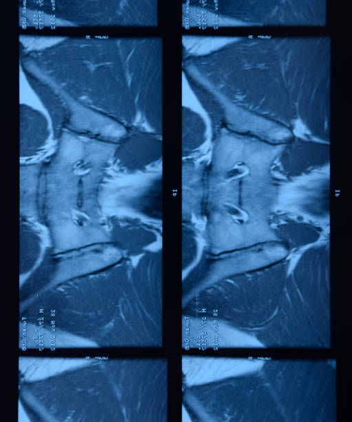 mri sacroiliac 관절. 강직성 척추 관절염 환자의 연구. - x ray image x ray back low 뉴스 사진 이미지