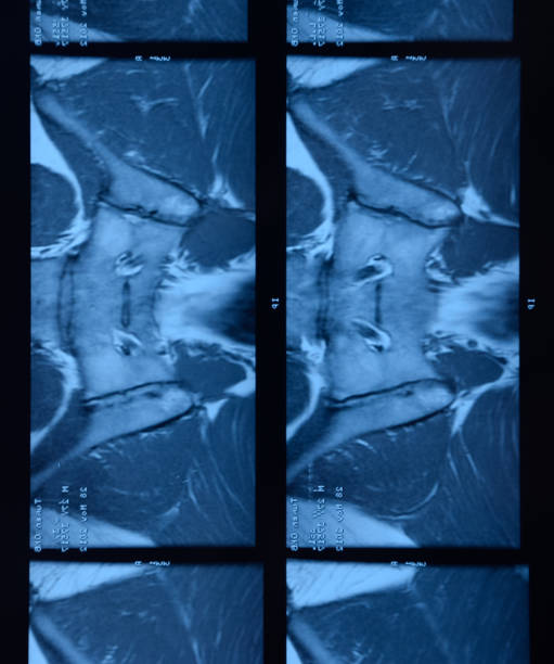 articulação sacroilíaca de rm. estudo do paciente anquilososo do espondiloartrite. - x ray image x ray back low - fotografias e filmes do acervo