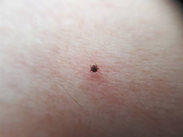 istock sucking tick, ixodes ricinus, sucking on a human 1170364719