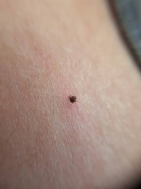 istock Plague ticks. Lyme disease and meningitis 1170364827