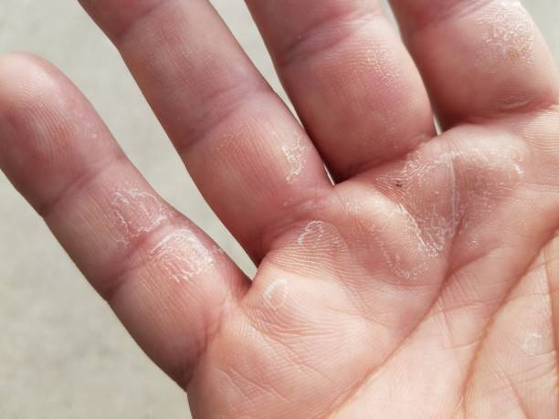 istock dry, flaky, itchy and peeling fingers on hand 1170390118