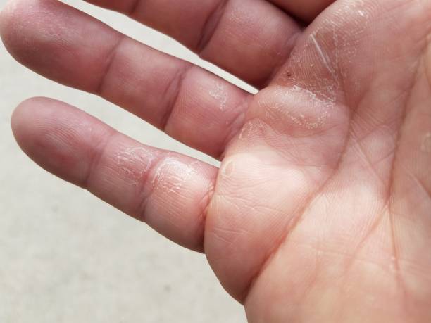 istock dry, flaky, itchy and peeling fingers on hand 1170390155