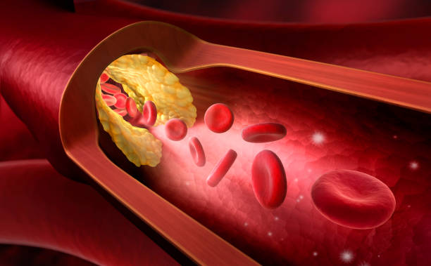 istock Artery blocked with cholesterol - stock photo 1170446182